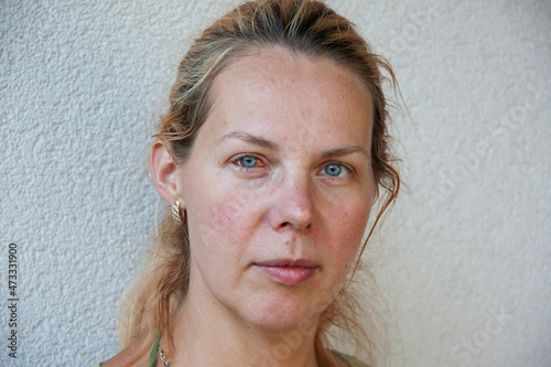 Portrait of a young tired woman. The right eye is sick with keratitis. Problem skin of the face, covered with rosacea and Acne. Isolated on light background. Outdoor photo