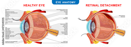 Retinal Detachment, anatomical diagram of the eye. Medicinal educational information. Vector illustration. photo