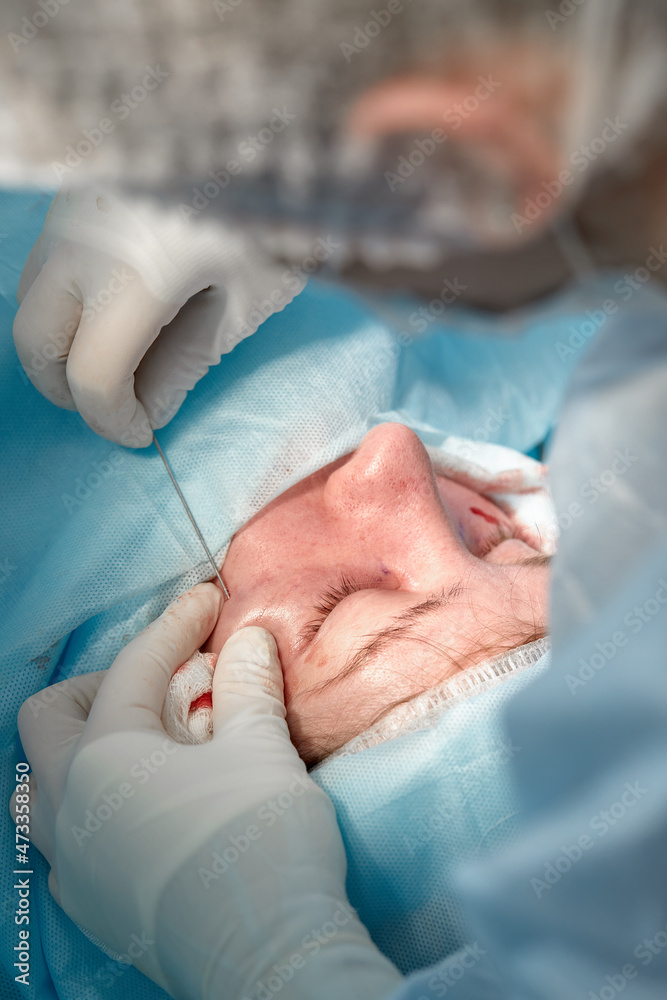 Close up of the face of a patient who is undergoing blepharoplasty. The surgeon cuts the eyelid and performs manipulations using medical instruments Close up of the face of a patient who is undergoing blepharoplasty. The surgeon cuts the eyelid and performs manipulations using medical instruments
