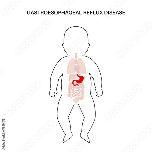GERD in infant body
