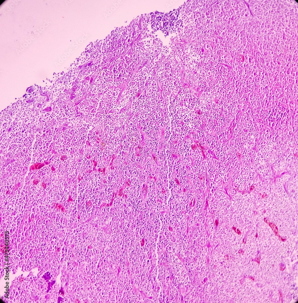 Stockfoto Olfactory neuroblastoma(ONB) or Esthesio neuroblastoma