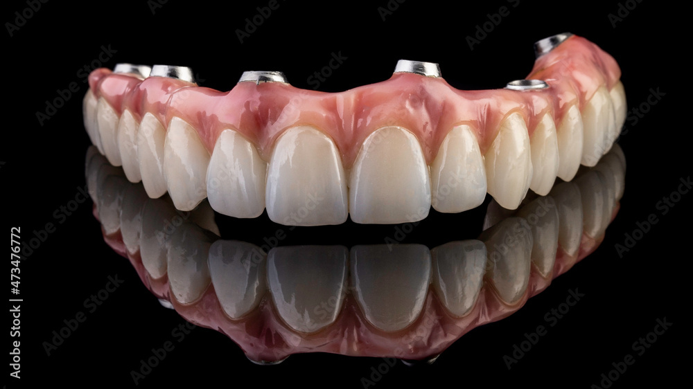 dentures on a black background, dental implants
dentures on a black background, dental implants