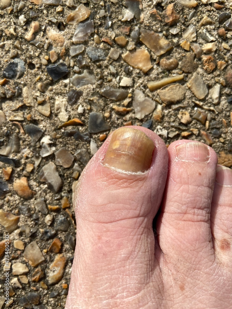Toenail nail fungus big toe of a person suffering from Onychomycosis