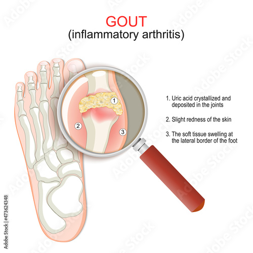 Gout. Close-up of joint with inflammatory arthritis.
