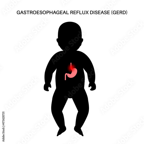 GERD in infant body