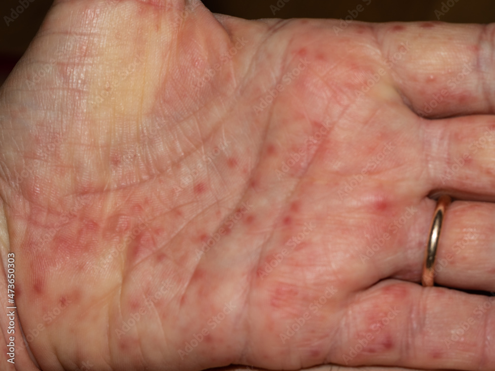 hand of a person with scarlet fever infection hand of a person with scarlet fever infection