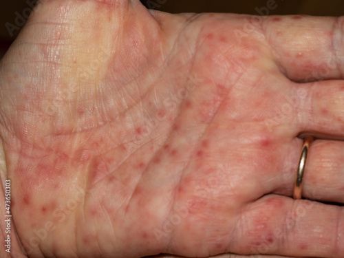 hand of a person with scarlet fever infection  photo