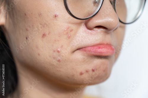 Close up of worried Asian woman having acne inflamed on her face. Inflamed acne consists of swelling, redness, and pores that are deeply clogged with bacteria, oil, and dead skin cells.
