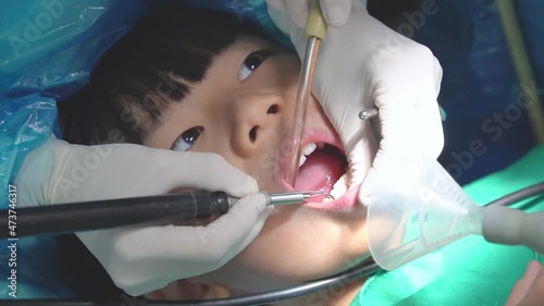Slow motion close up of dentist's hand with medical glove using scaler scaling teeth of cute little Asian child to remove plaque and cavity. Dental hygiene, good oral health care habits.