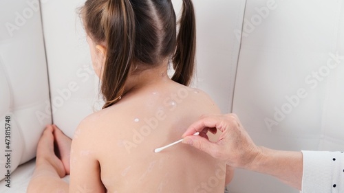 Fotografie Female hands treat a rash of chickenpox on the body of a little girl with atiseptic cream at home