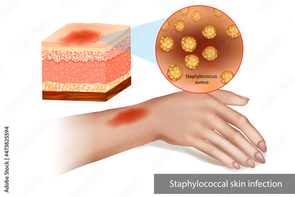 Staphylococcal skin infection or Staph infection. Superimposed bacterial infection  Skin cellulitis. Stock Illustration | Adobe Stock