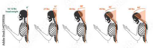 Computer neck syndrome, tech neck, text neck. Changes in pressure on the cervical spine with different head positions. Flat vector illustration is isolated on white background