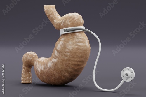 Realistic 3D Render of Stomach with Gastric Band photo