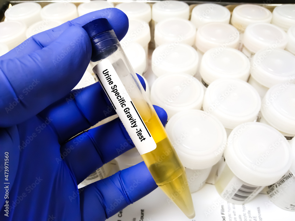 Urine sample for Urine specific gravity test, It can help determine how