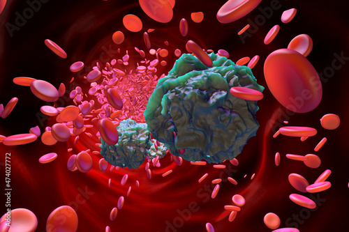 Three dimensional render of leukemia cells in blood stream