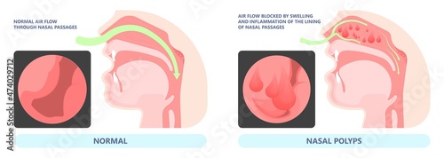 Nasal polypectomy Throat back voice box larynx vocal cord pain airway endoscopic sinus surgery ear nose sleep apnea oral airway septal obstructive biopsy tumor Pharynx flexible fibre optic photo