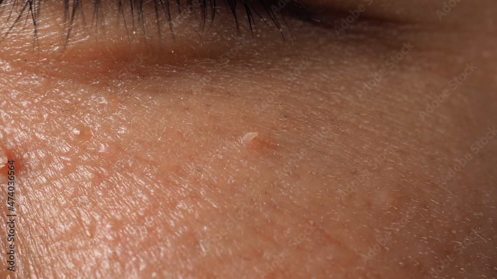 Fototapeta premium Wart on face. Macro shot of wart near eye. Papilloma on skin around eye nose and neck. Close up of birthmark Papilla or mole on skin. small hard. benign growth on the skin. caused by virus. skincare.