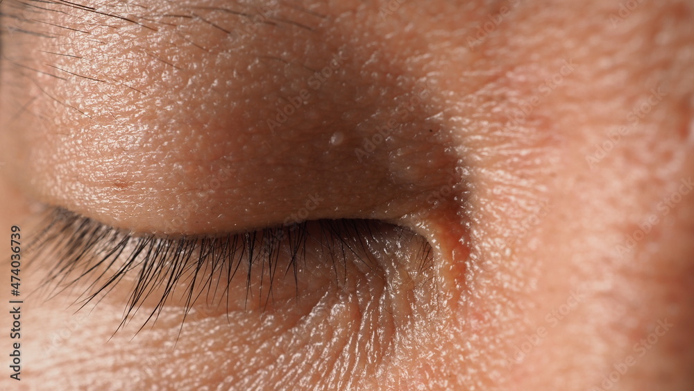 Obraz premium Wart on face. Macro shot of wart near eye. Papilloma on skin around eye nose and neck. Close up of birthmark Papilla or mole on skin. small hard. benign growth on the skin. caused by virus. skincare.
