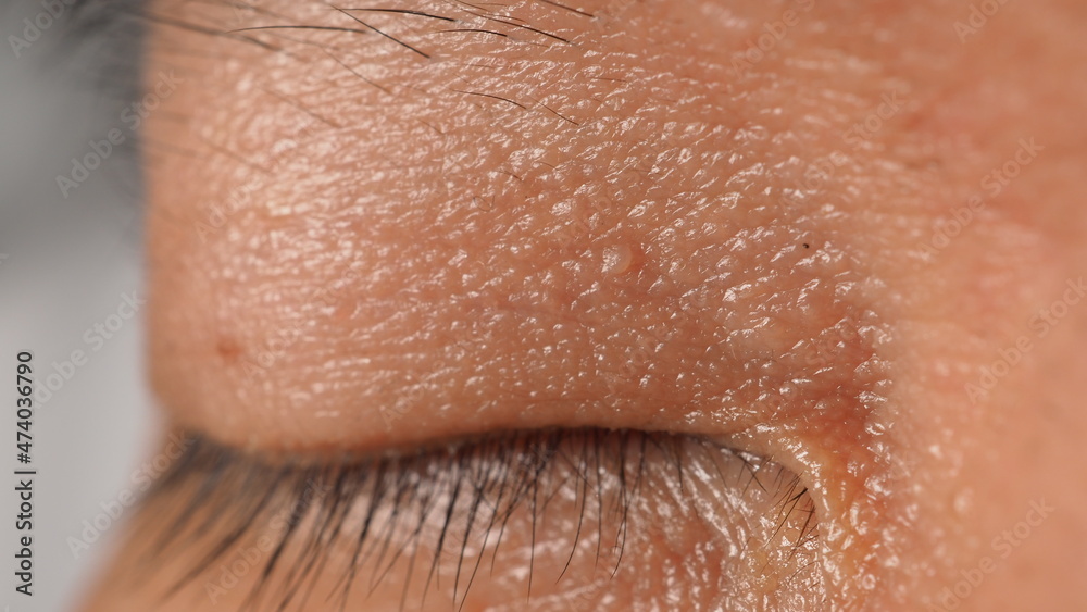 Fototapeta premium Wart on face. Macro shot of wart near eye. Papilloma on skin around eye nose and neck. Close up of birthmark Papilla or mole on skin. small hard. benign growth on the skin. caused by virus. skincare.