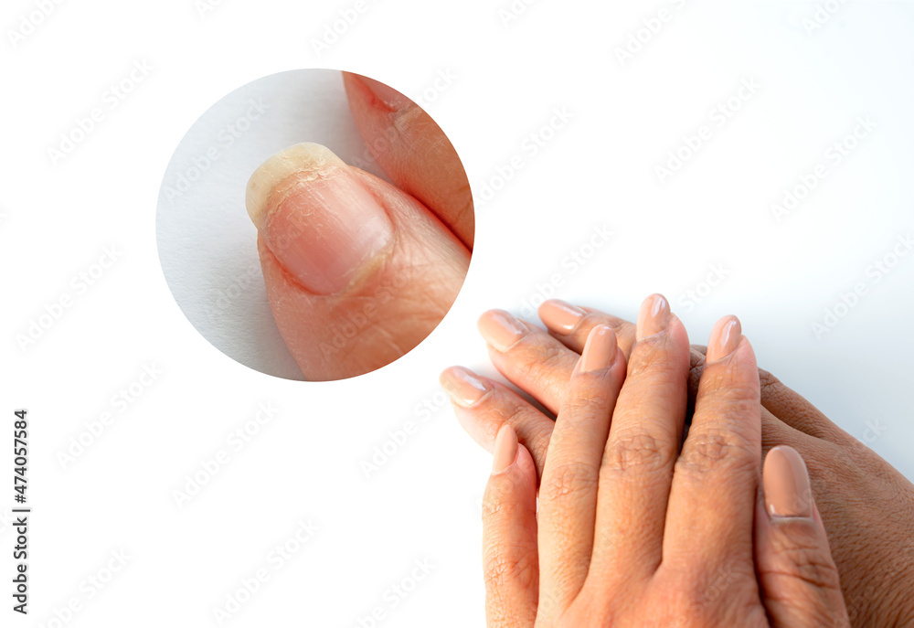 Closeup Of Thumb And Nail With Dry Skin Torn And Flaking Off Cracked Skin  On Cuticles Dry Brittle Nails Broken Fingernails Inflammation Chipped Nails  Isolated On White Background Stock Photo - Download