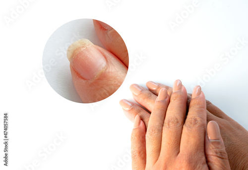 Zoom in image of brittle weak dry cracked pitted woman's fingernails surface and prone to breakage caused by harsh ingredients in nail polish formulas on white background. photo
