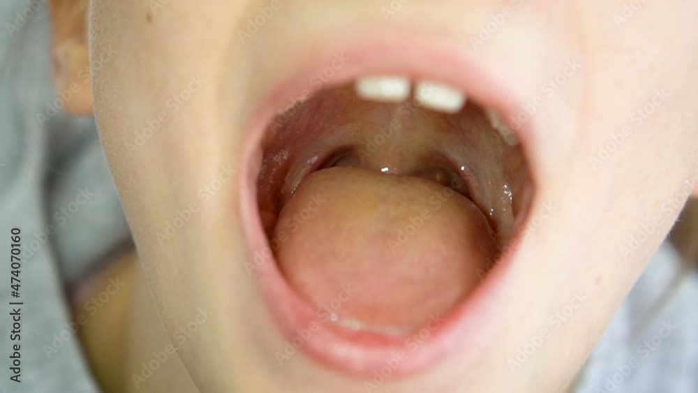 Wide open mouth with a tongue stuck out, view of the uvula ...  
