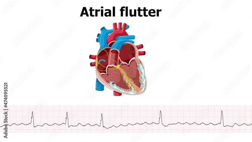 heart animation atrial flutter arrhythmia with ecg Stock Video | Adobe Stock