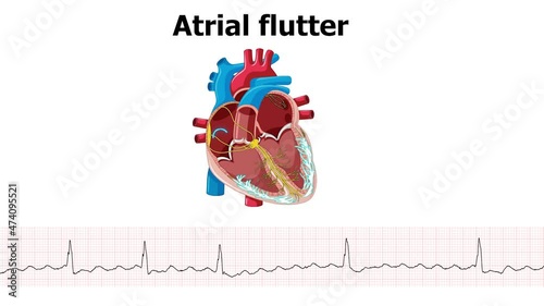 heart animation atrial flutter arrhythmia with ecg photo