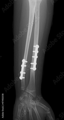 Fotografia x ray of  broken hand ,internal fixation plate and screw on ulna and radius