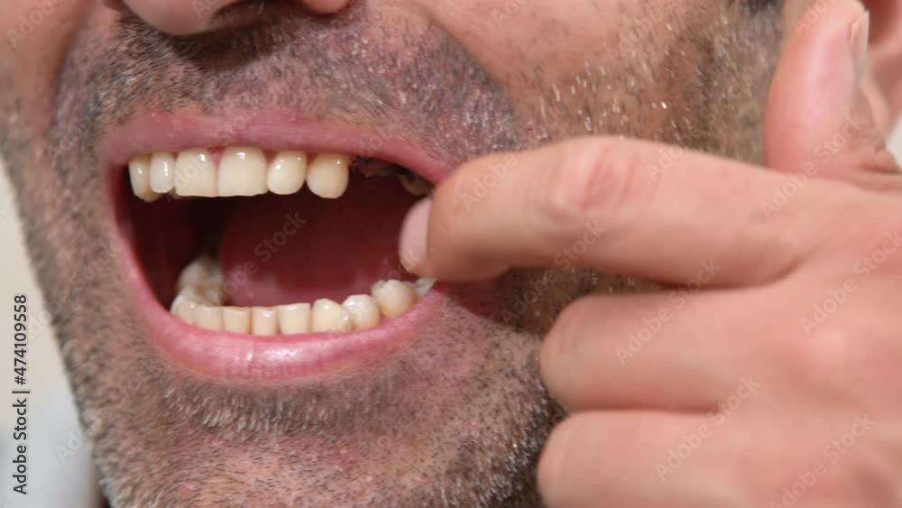 Experiencing tooth loss. Mouth close-up tooth loss.
