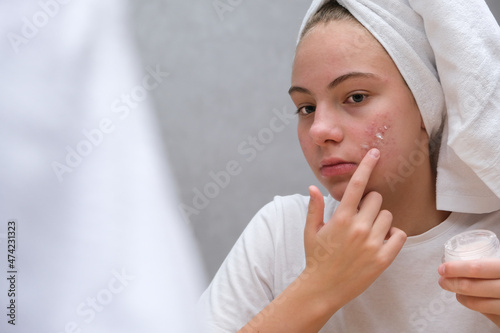 teenage girl . Acne. Care for problem skin