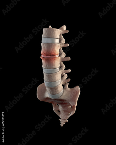 Lumbar spine with stenosis condition on black background photo