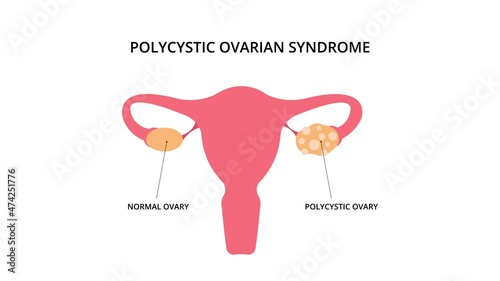Polycystic ovarian syndrome 2D animation. Uterus, infertility, gynecology. For topics like pcos, disease, pelvic floor photo