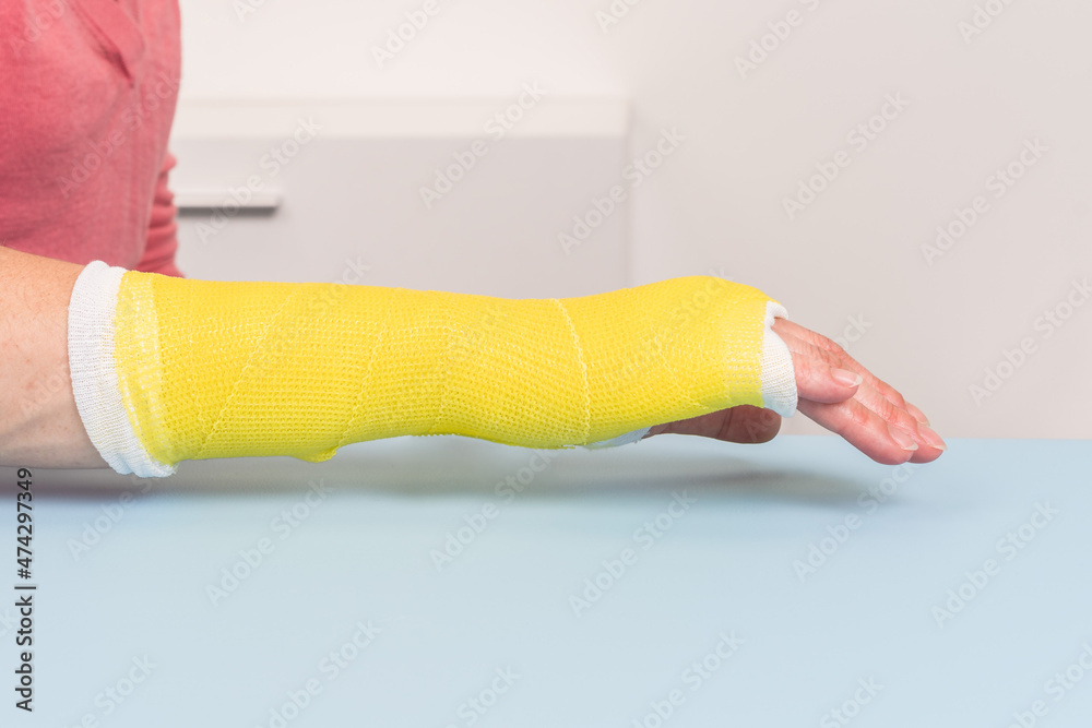 Surgery and Medical theme Close up of an arm and wrist plaster