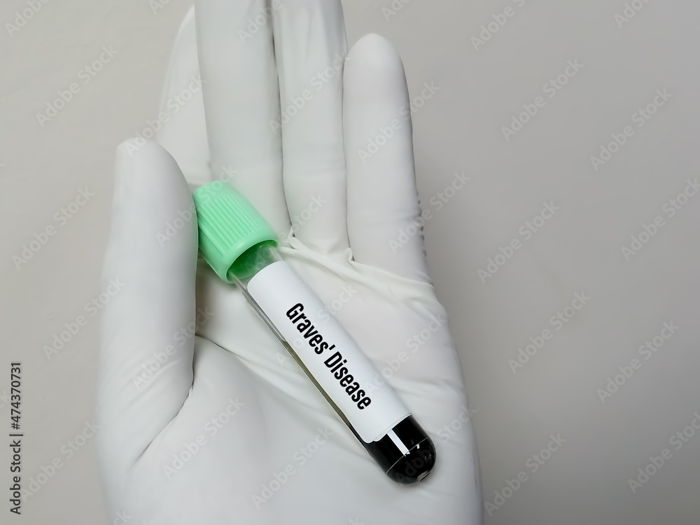Blood sample tube for Graves' disease test at medical laboratory