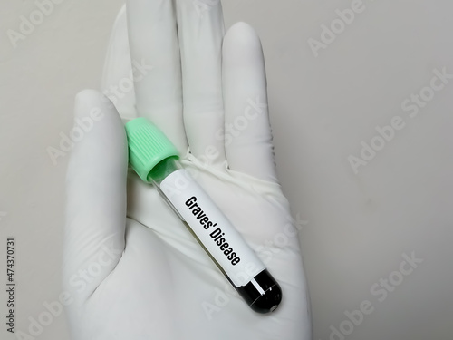 Blood sample tube for Graves' disease test at medical laboratory. Autoimmune disease that affects the thyroid gland. The gland produces too much thyroid hormone photo