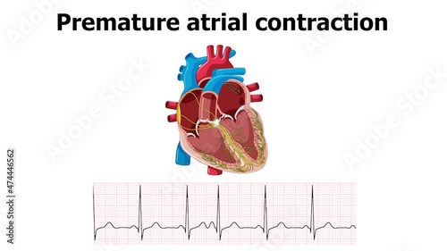 heart arrhythmia premature atrial contraction (APC) with ecg photo