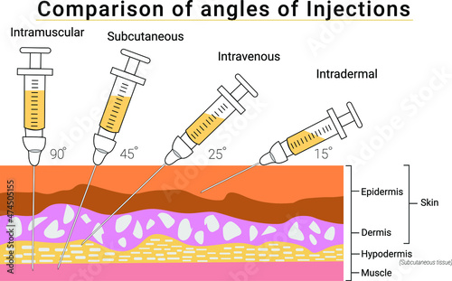 Vector of comparison of angles of injections. Illustration of injection syringe on the skin layers. Types of injections demonstration such as intramuscular, subcutaneous, intravenous, and intradermal. photo