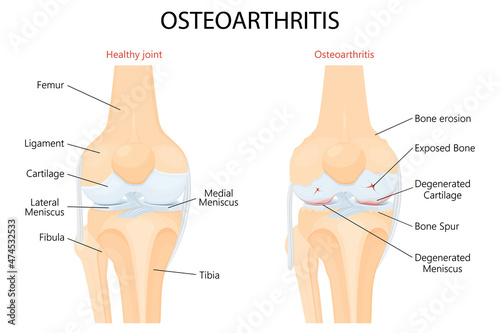 Knee Osteoarthritis and normal joint detailed anatomy. Osteoarthritis. Arthritis or pain within a joint. degenerative joint disease. Cartilage becomes worn. Vector flat design photo
