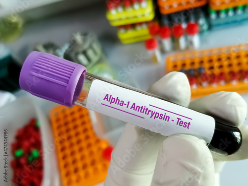 Scientist hold blood sample tube for Alpha 1 antitrypsin (A1AT) Test. alpha-1 antitrypsin deficiency, COPD photo