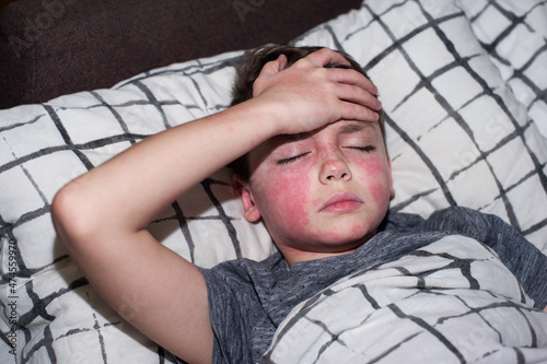 a boy of European appearance with red spots on his face is lying in bed with his hand on his forehead photo