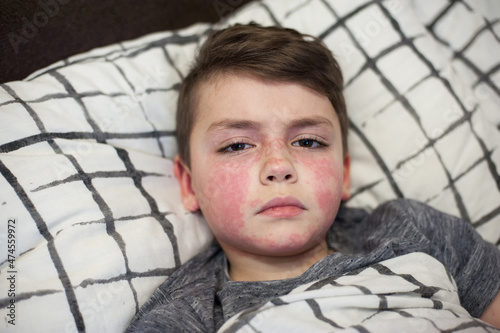 a boy of European appearance with the first signs of the virus, red spots on his face. Allergy on the child's face photo