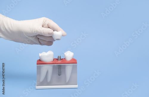 Hand holds a model of tooth implantation.
