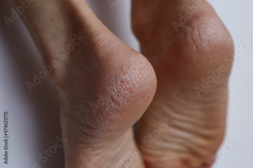 Dry female feet, cracked heel requires skin care spa