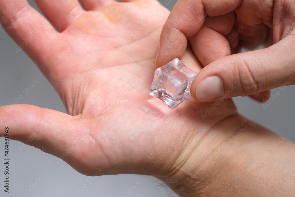 A man's hand is rubbing calluses with an ice cube