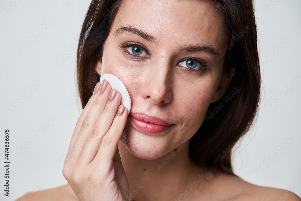 Brunette attractive woman with post acne spots cleaning her face with a cotton pad Brunette attractive woman with post acne spots cleaning her face with a cotton pad