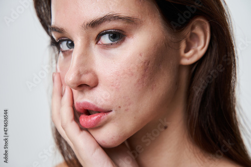 Woman with with post acne spots at her face looking at the camera photo