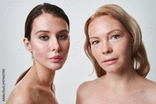 One woman with clear fresh skin and another having acne symptoms photo