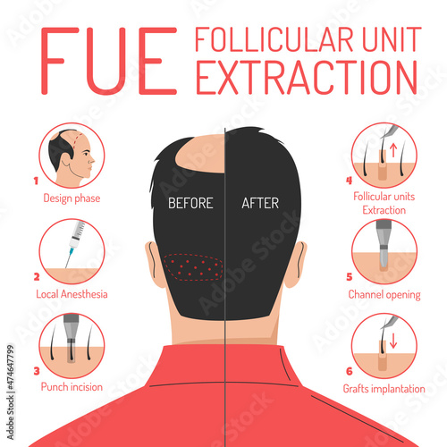 FUE hair transplantation process vector isolated. Follicular unit extraction procedure. Baldness problem, surgical treatment. Graft implantation, medical infographic. photo