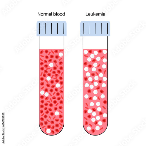 Leukemia cancer disease
